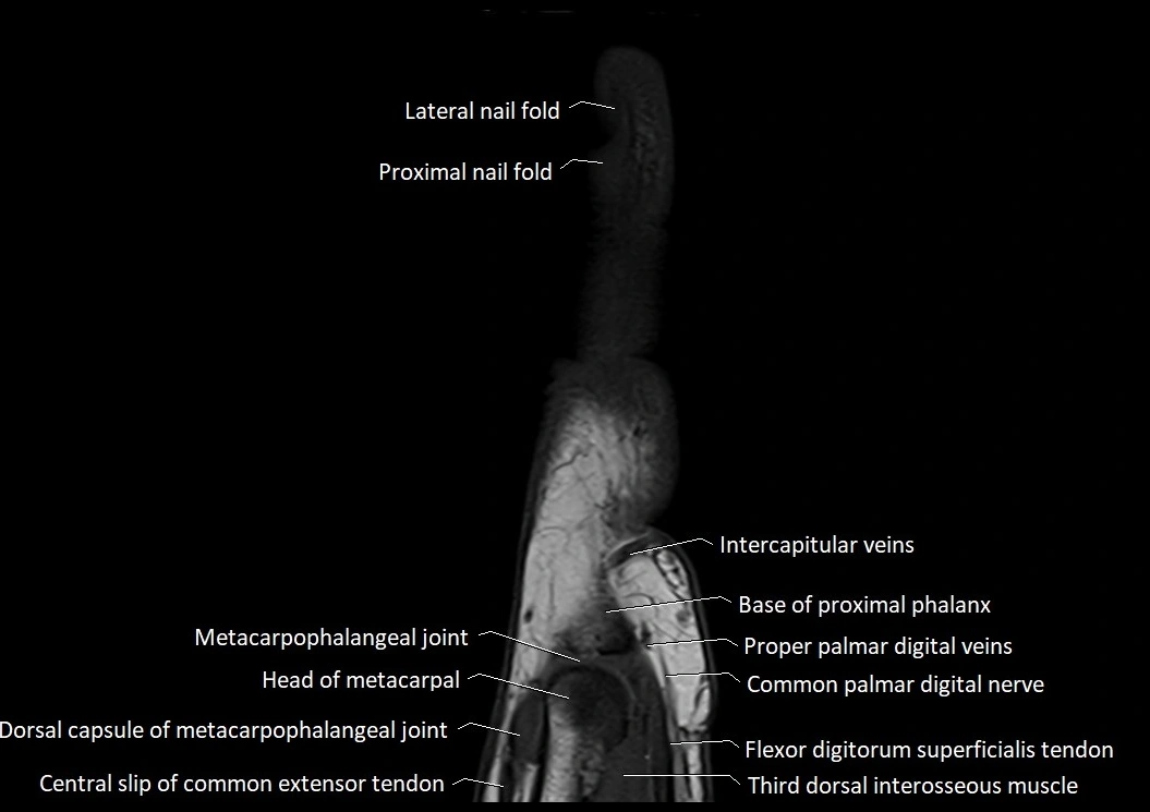 Finger anatomy sagittall cross section 3T image 9.webp